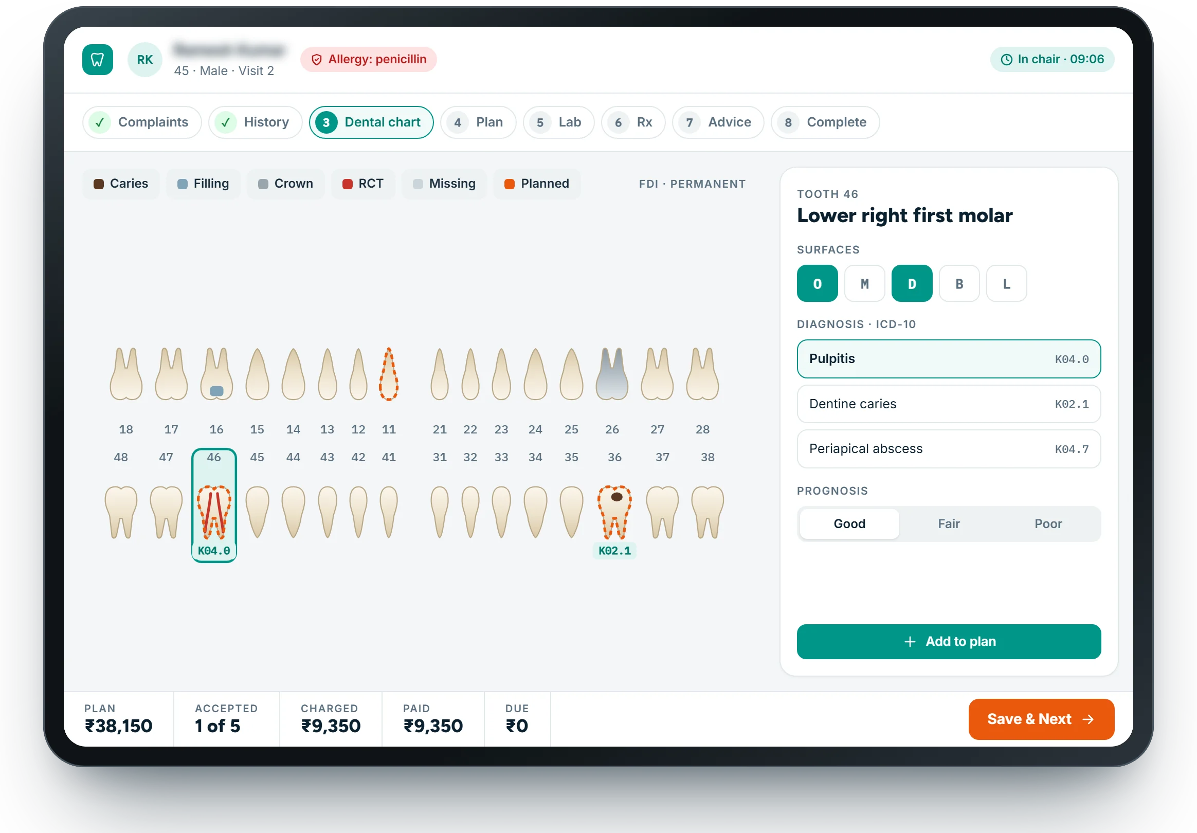 NexHIS Dental chart on a tablet: FDI teeth, tooth 46 with pulpitis K04.0 and the diagnosis panel